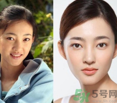 開眼角眼睛會變大嗎？開眼角眼睛能大多少？