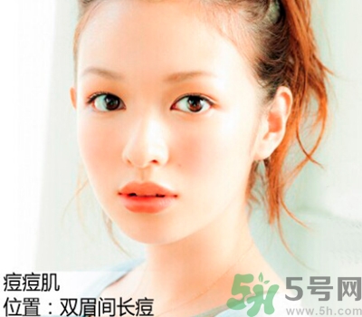 眉心長(zhǎng)痘痘是什么原因？眉心長(zhǎng)痘痘怎么辦？
