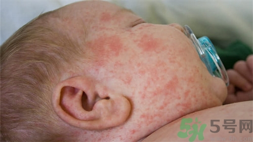 長痱子用花露水可以嗎?長痱子用什么好 長痱子用花露水可以嗎?長痱子用什么好