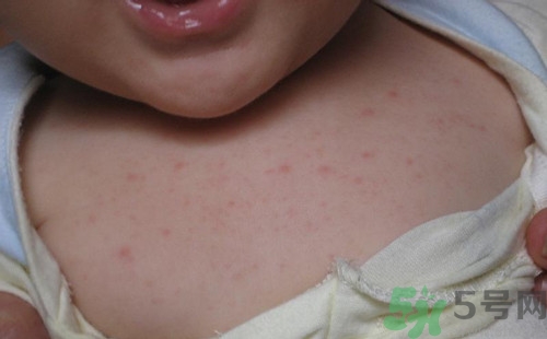 長(zhǎng)痱子用花露水可以嗎?長(zhǎng)痱子用什么好 長(zhǎng)痱子用花露水可以嗎?長(zhǎng)痱子用什么好