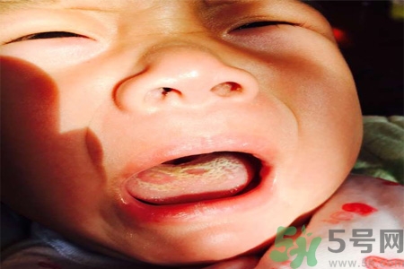 舌頭燙傷后該怎么辦呢？舌頭燙傷后應(yīng)該注意吃什么？?