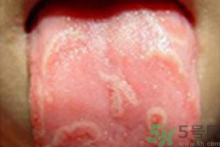 舌頭燙傷后該怎么辦呢？舌頭燙傷后應(yīng)該注意吃什么？?