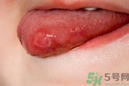 舌頭長泡怎么辦？舌頭長泡的原因？