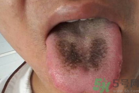 舌頭發(fā)黑怎么回事？舌頭發(fā)黑怎么辦？
