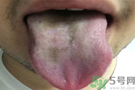 舌頭發(fā)黑怎么回事？舌頭發(fā)黑怎么辦？