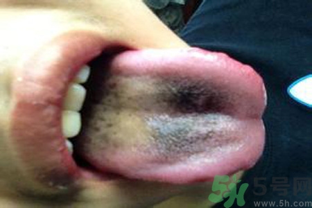 舌頭發(fā)黑怎么回事？舌頭發(fā)黑怎么辦？