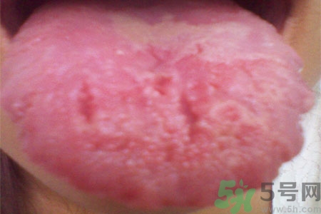 舌頭上有裂紋是怎么辦？舌頭上有裂紋是什么原因？