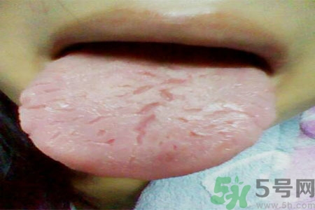 舌頭上有裂紋是怎么辦？舌頭上有裂紋是什么原因？