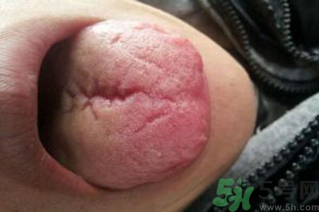 舌頭上有裂紋是怎么辦？舌頭上有裂紋是什么原因？