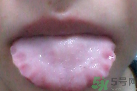 舌頭上有齒痕怎么回事？舌頭上有齒痕怎么辦？