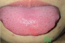 舌頭上有齒痕怎么回事？舌頭上有齒痕怎么辦？