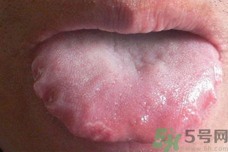 舌頭上有齒痕怎么回事？舌頭上有齒痕怎么辦？