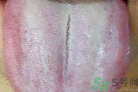 舌頭發(fā)白是什么原因？舌苔發(fā)白是怎么辦？