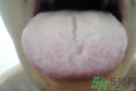 舌頭發(fā)白是什么原因？舌苔發(fā)白是怎么辦？