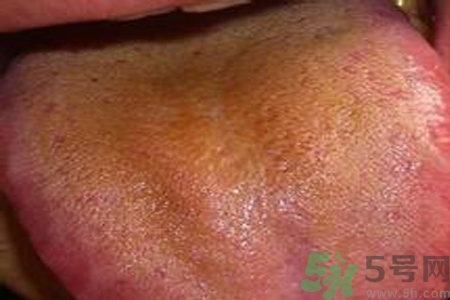 舌苔厚黃是怎么回事？舌頭發(fā)黃怎么辦？