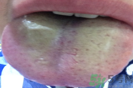 舌苔厚黃是怎么回事？舌頭發(fā)黃怎么辦？