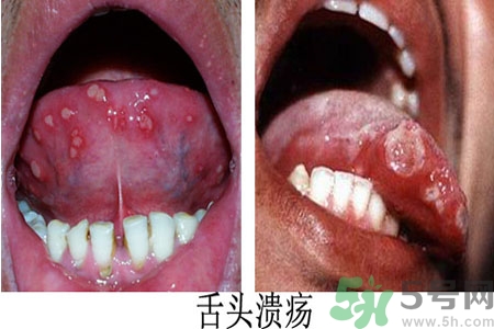 舌頭潰瘍怎么辦？舌頭潰瘍的原因？