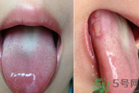 舌頭潰瘍怎么辦？舌頭潰瘍的原因？