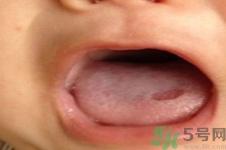 舌頭潰瘍?cè)趺崔k？舌頭潰瘍的原因？