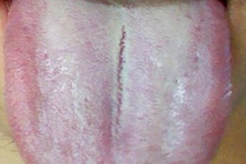 舌頭發(fā)白是什么原因？舌苔發(fā)白是怎么辦？