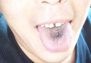 舌頭發(fā)黑怎么回事？舌頭發(fā)黑怎么辦？