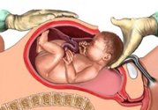 剖腹產(chǎn)橫剖好還是豎剖好？剖腹產(chǎn)橫剖和豎剖有什么區(qū)別？