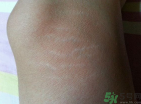 肥胖紋能去掉嗎？ 肥胖紋瘦了以后會消失嗎？