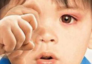 寶寶得了紅眼病怎么辦？寶寶得了紅眼病怎么治？
