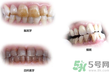 四環(huán)素牙是什么？四環(huán)素牙是怎么形成的？