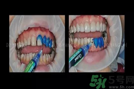 四環(huán)素牙是什么？四環(huán)素牙是怎么形成的？