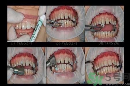 四環(huán)素牙是什么？四環(huán)素牙是怎么形成的？