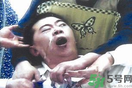 癲癇的典型癥狀有哪些？癲癇是什么？