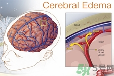 癲癇的發(fā)病因素？癲癇的并發(fā)癥有哪些？