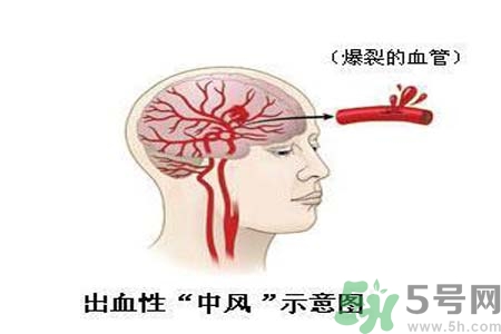腦中風(fēng)的護理措施？腦中風(fēng)的飲食護理？