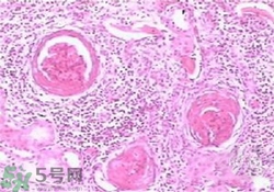 慢性腎炎能治好嗎？慢性腎炎能活多久？