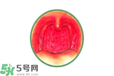 慢性咽炎的治療方法？慢性咽炎的藥物治療？