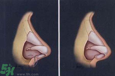 鼻竇炎的護(hù)理措施？鼻竇炎的飲食護(hù)理？