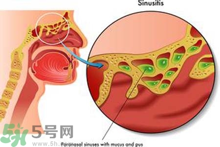 鼻竇炎的護(hù)理措施？鼻竇炎的飲食護(hù)理？