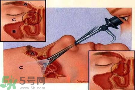 鼻竇炎的護(hù)理措施？鼻竇炎的飲食護(hù)理？