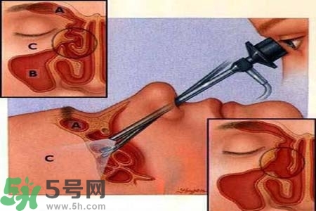 鼻竇炎的高發(fā)人群？如何預(yù)防鼻竇炎？