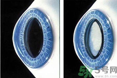 白內(nèi)障的發(fā)病因素是什么？白內(nèi)障并發(fā)癥有哪些？