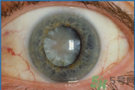 白內(nèi)障治療方法是什么？白內(nèi)障可以用什么藥物治療？