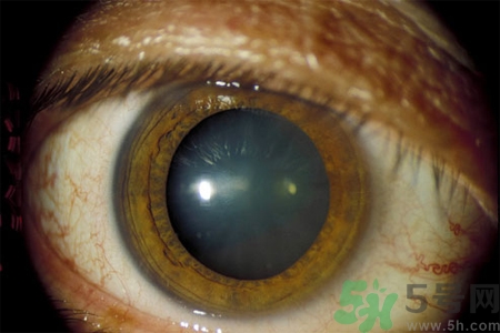 白內(nèi)障治療方法是什么？白內(nèi)障可以用什么藥物治療？