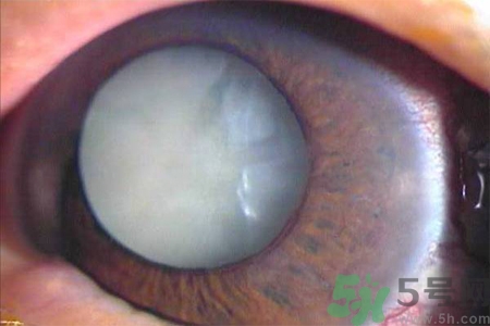 白內(nèi)障治療方法是什么？白內(nèi)障可以用什么藥物治療？