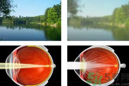 白內(nèi)障的高發(fā)人群有哪些？如何預(yù)防白內(nèi)障？