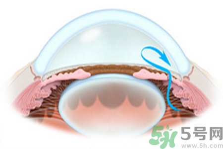 青光眼的治療方法有哪些？青光眼可以哪些藥物治療？