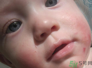寶寶長奶蘚怎么回事？寶寶長奶蘚怎么辦？
