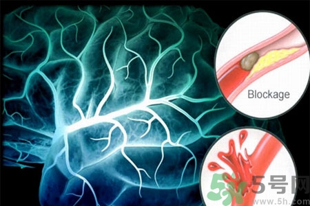 腦出血的發(fā)病因素是什么？腦出血的并發(fā)癥有哪些？