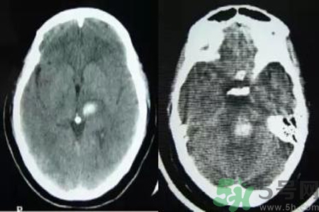 腦出血的發(fā)病因素是什么？腦出血的并發(fā)癥有哪些？