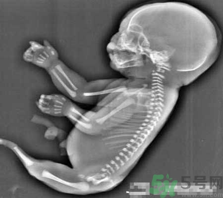 媽媽懷上人魚寶寶 什么是美人魚綜合癥？